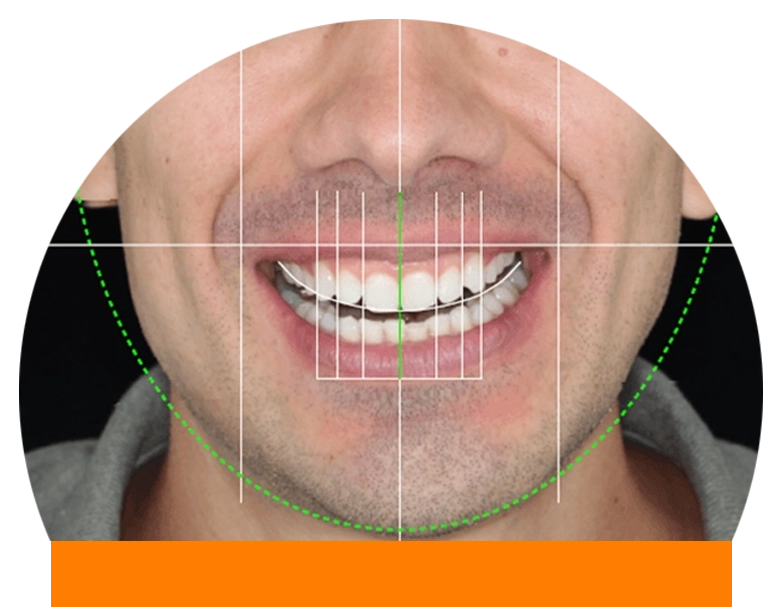 aparelho-invisivel-alinhamento-dentes-balneario-camboriu.jpg Paciente mostrando o resultado de dentes perfeitamente alinhados e brancos após tratamento ortodôntico estético na Clinica Cora em Balneário Camboriú.
