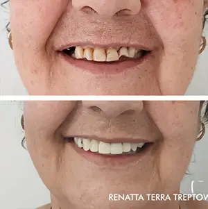 imagem-01-resultado-harmonizacao-facial-em-balneario-camburiu