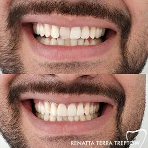 imagem-02-resultado-harmonizacao-facial-em-balneario-camburiu