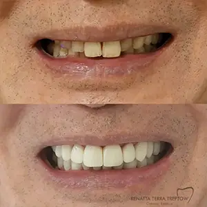 imagem-03-resultado-harmonizacao-facial-em-balneario-camburiu