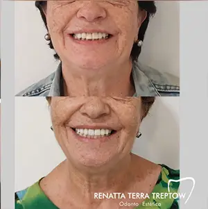 imagem-04-resultado-harmonizacao-facial-em-balneario-camburiu