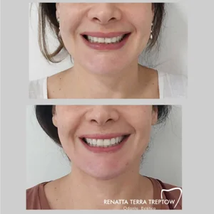 imagem-05-resultado-harmonizacao-facial-em-balneario-camburiu-02