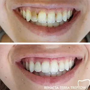 imagem-05-resultado-harmonizacao-facial-em-balneario-camburiu