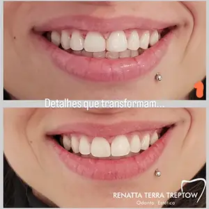 imagem-06-resultado-harmonizacao-facial-em-balneario-camburiu